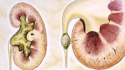 腎結(jié)石是怎么引起的？