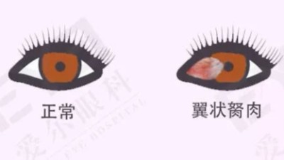 翼狀胬肉是什么？