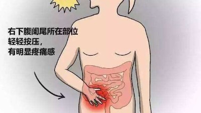 慢性闌尾炎需要切除嗎？