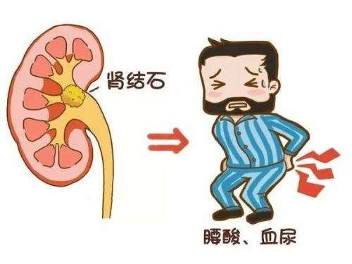 腎結石有什么癥狀